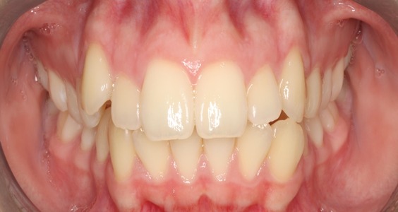 Before Teeth